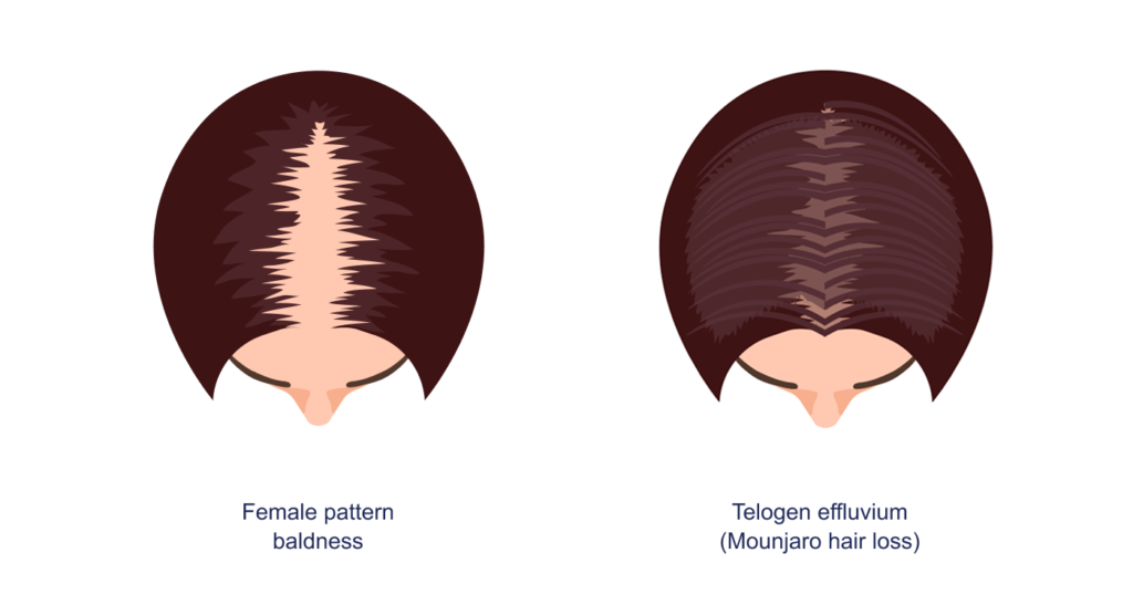 Does Mounjaro Cause Hair Loss?